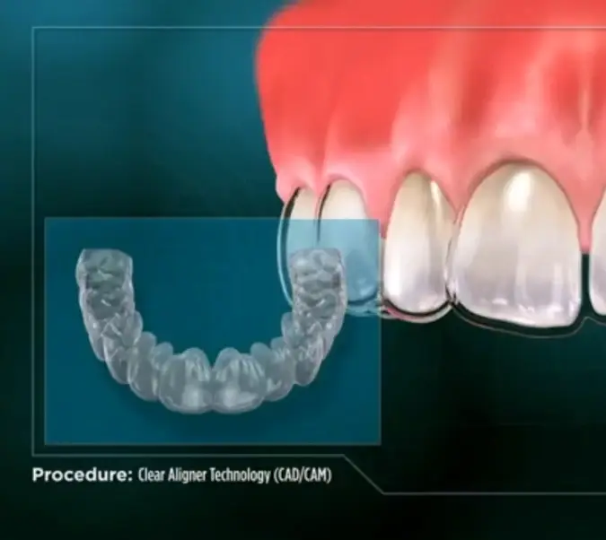 Clear aligner treatment illustration