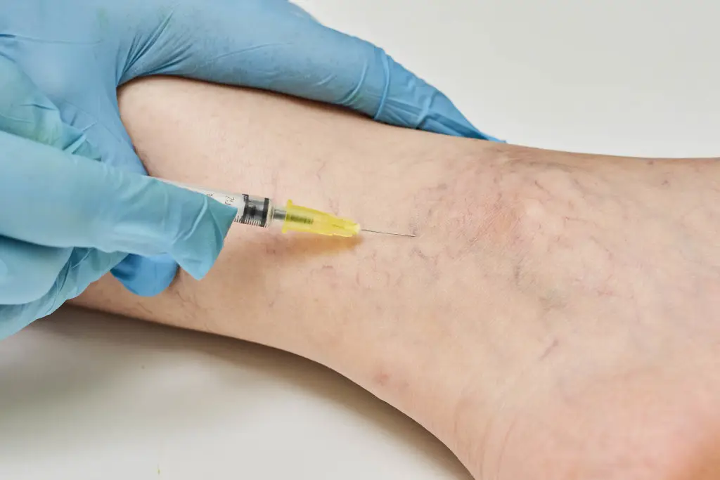 treatment-of-spider-veins