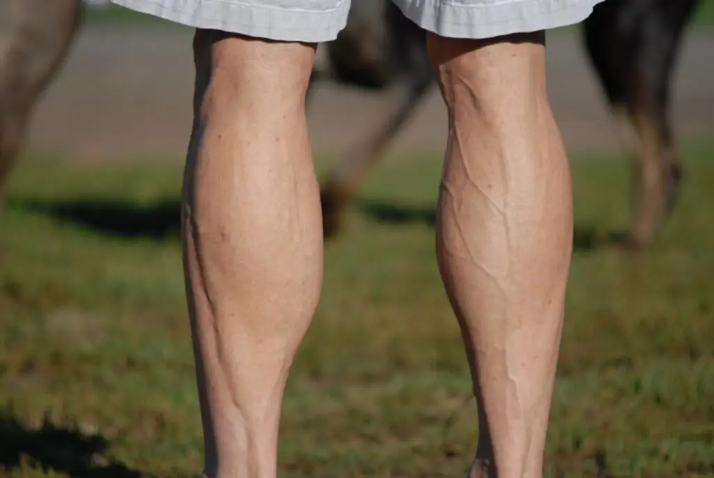 varicose-veins