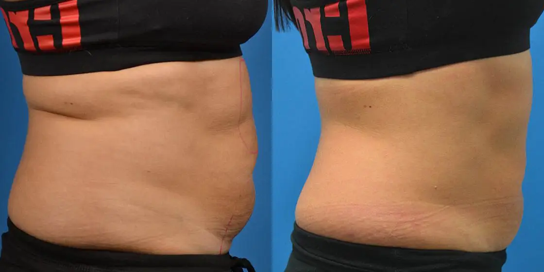 SMART LIPO IN HOUSTON, TX