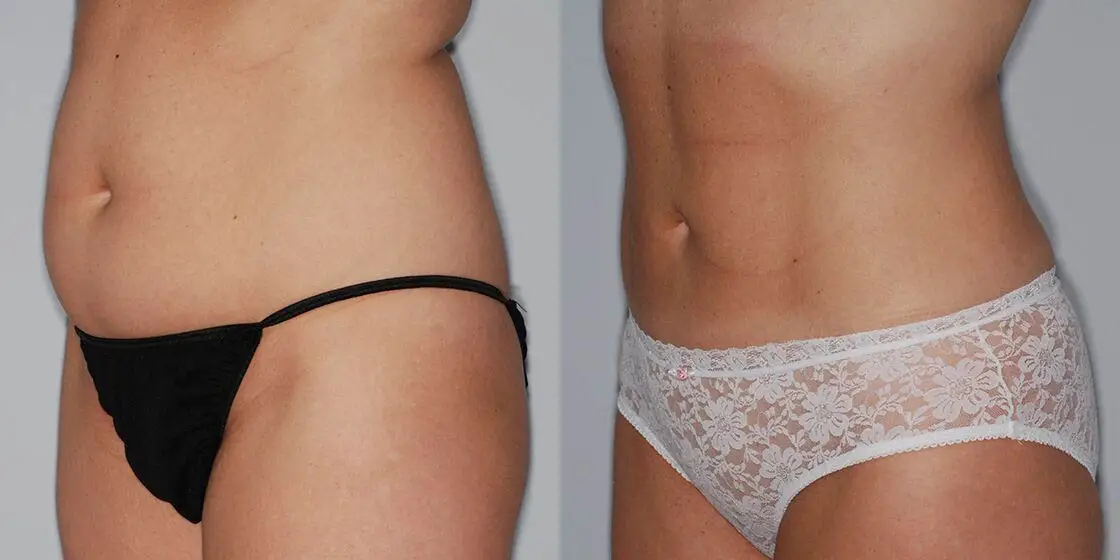 SMART LIPO IN HOUSTON, TX