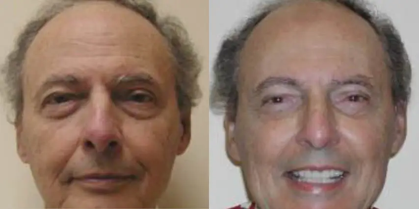 Eyelid Surgery Before and After