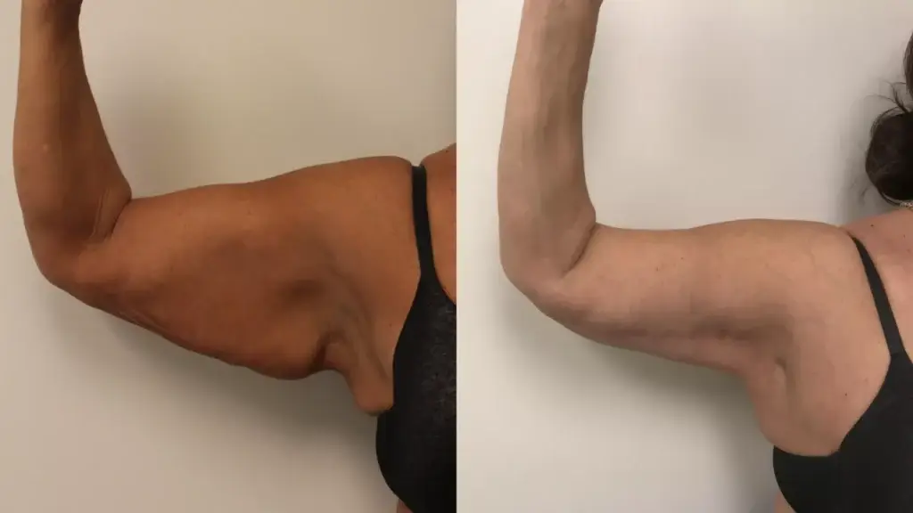 brachioplasty-right-bare-arms