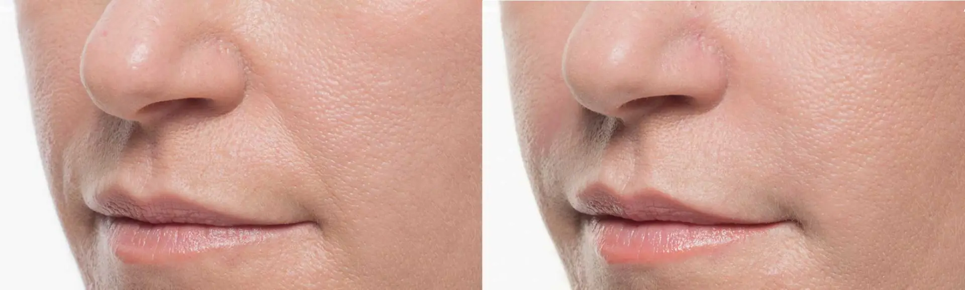 BellaFill Before and After