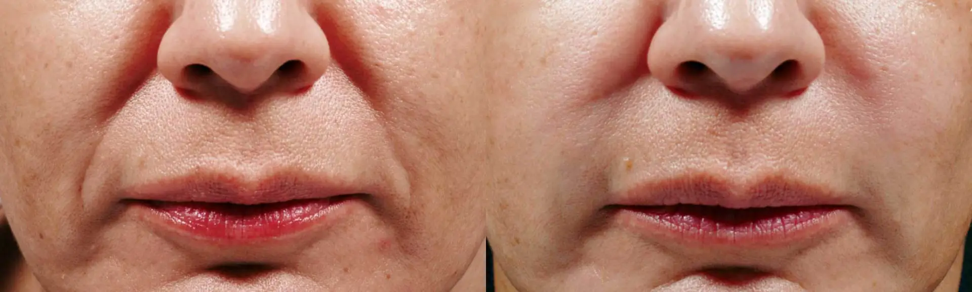 BellaFill Before and After