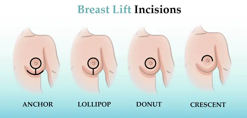 Breast Lift Incisions