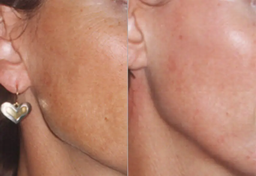 Chemical Peel Before and After