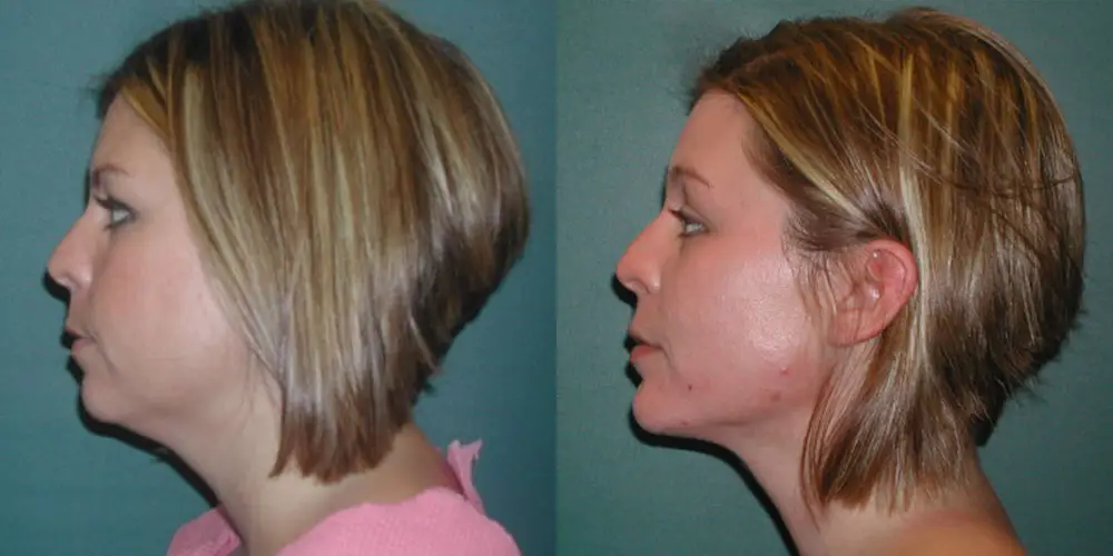 Chin Augmentation Before and After