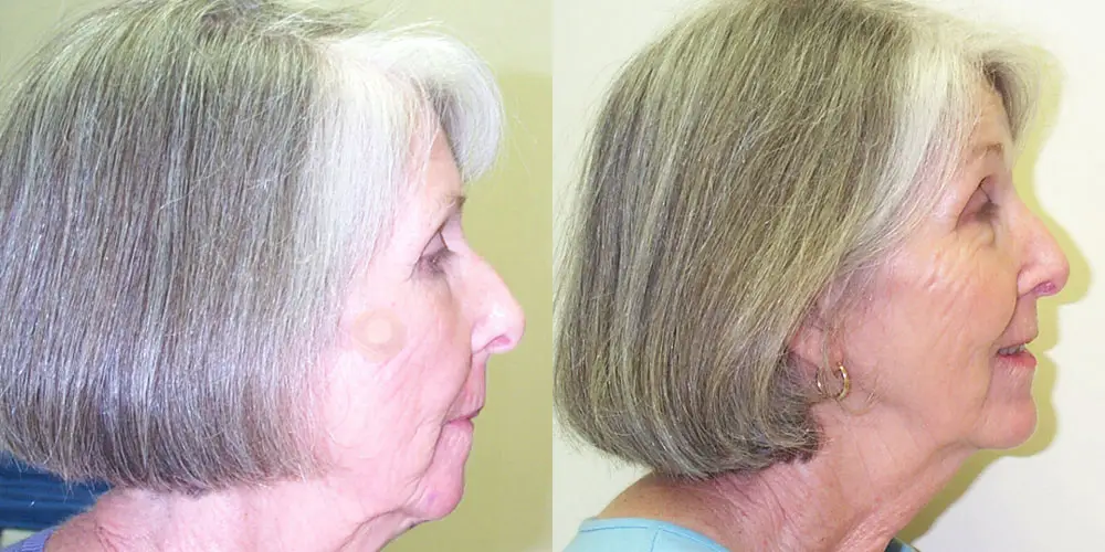 Chin Augmentation Before and After