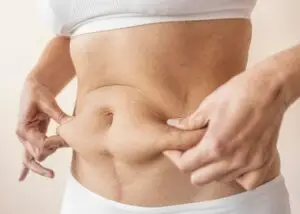 Post-Bariatric Body Contouring