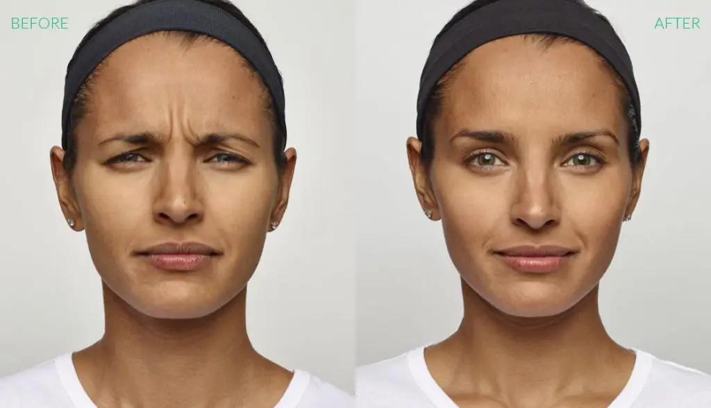 DYSPORT TREATMENTS Before and After