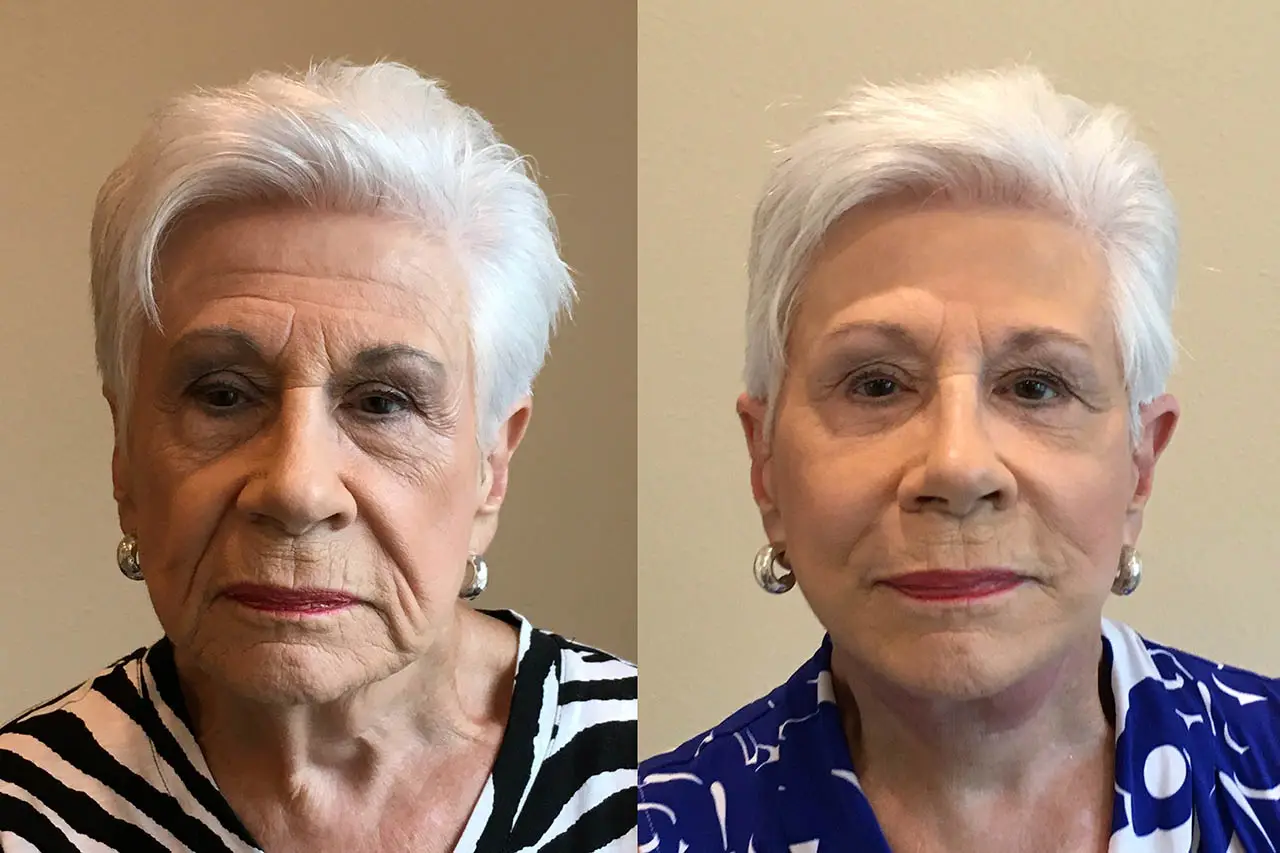 Facelifts Before and After