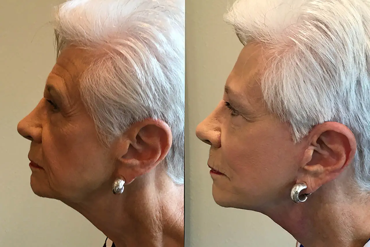Facelifts Before and After
