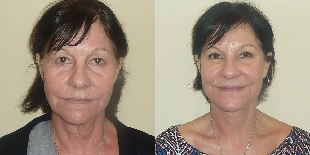 Facelift Before and After Photos