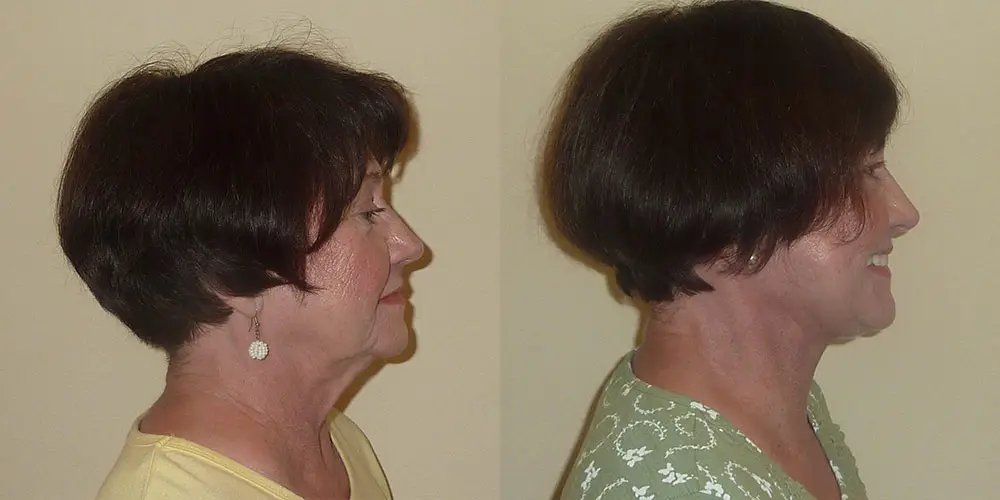 Facelift Before and After Photos