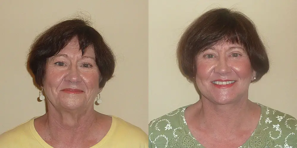 Facelift Before and After Photos