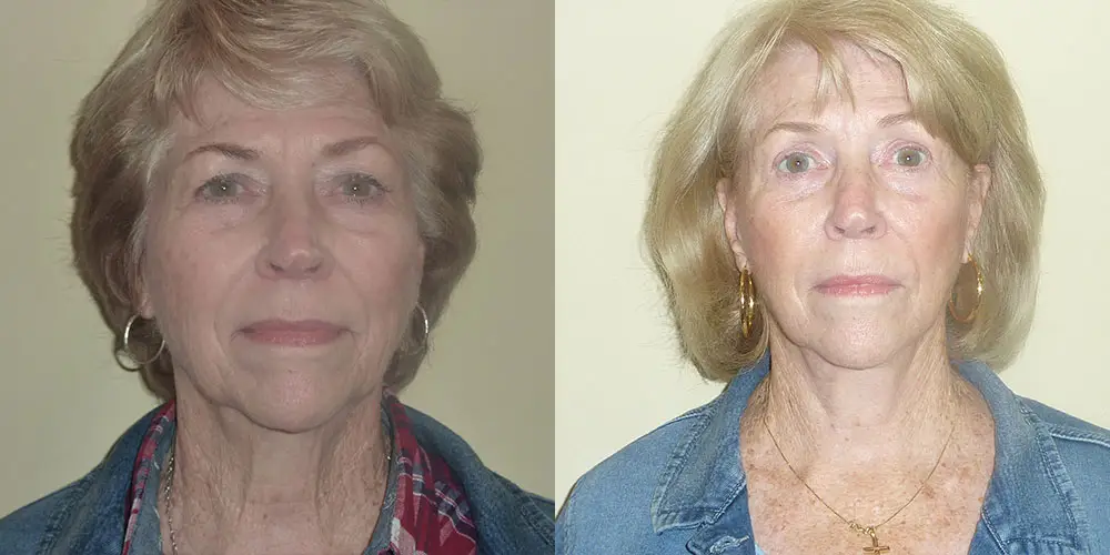 Facelift Before and After Photos