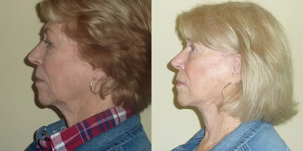 Facelift Before and After Photos