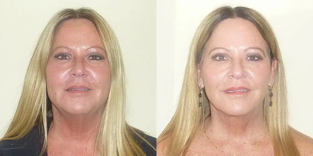 Facelift Before and After Photos