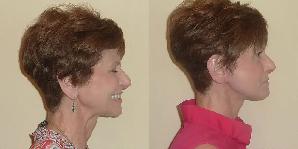 Facelift Before and After Photos