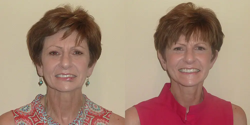 Facelift Before and After Photos