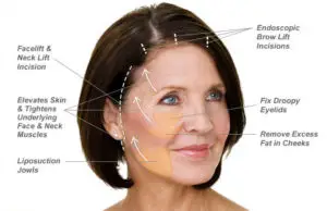 Facelift Process