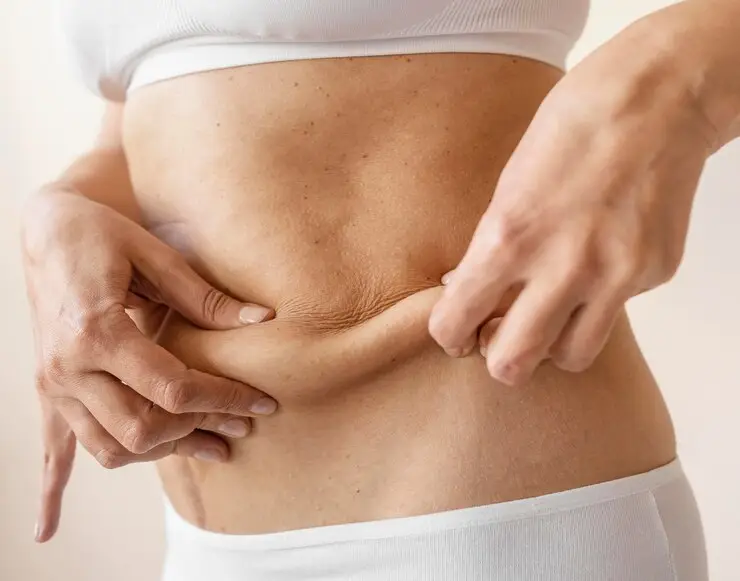 Tummy Tuck