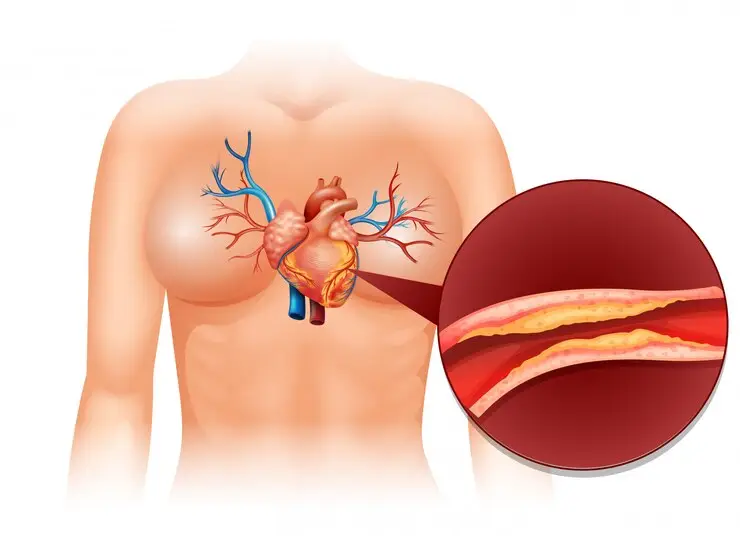 Blood Vessel Problems