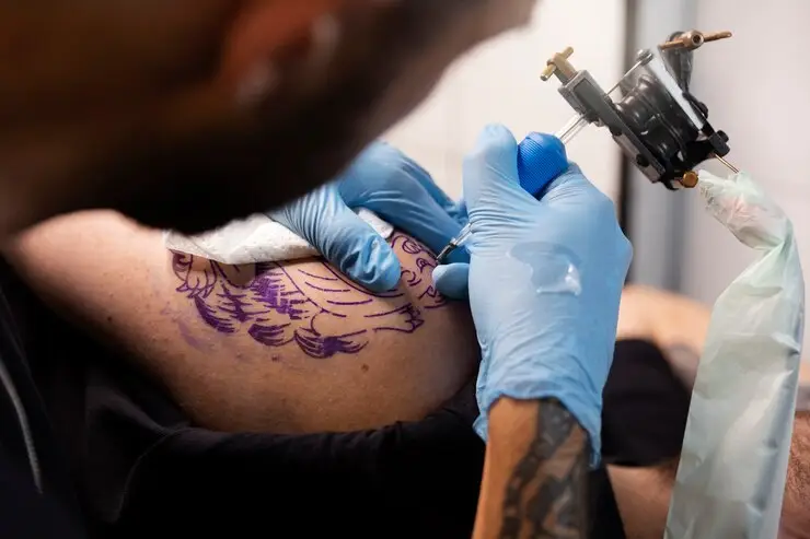 tattoo removal