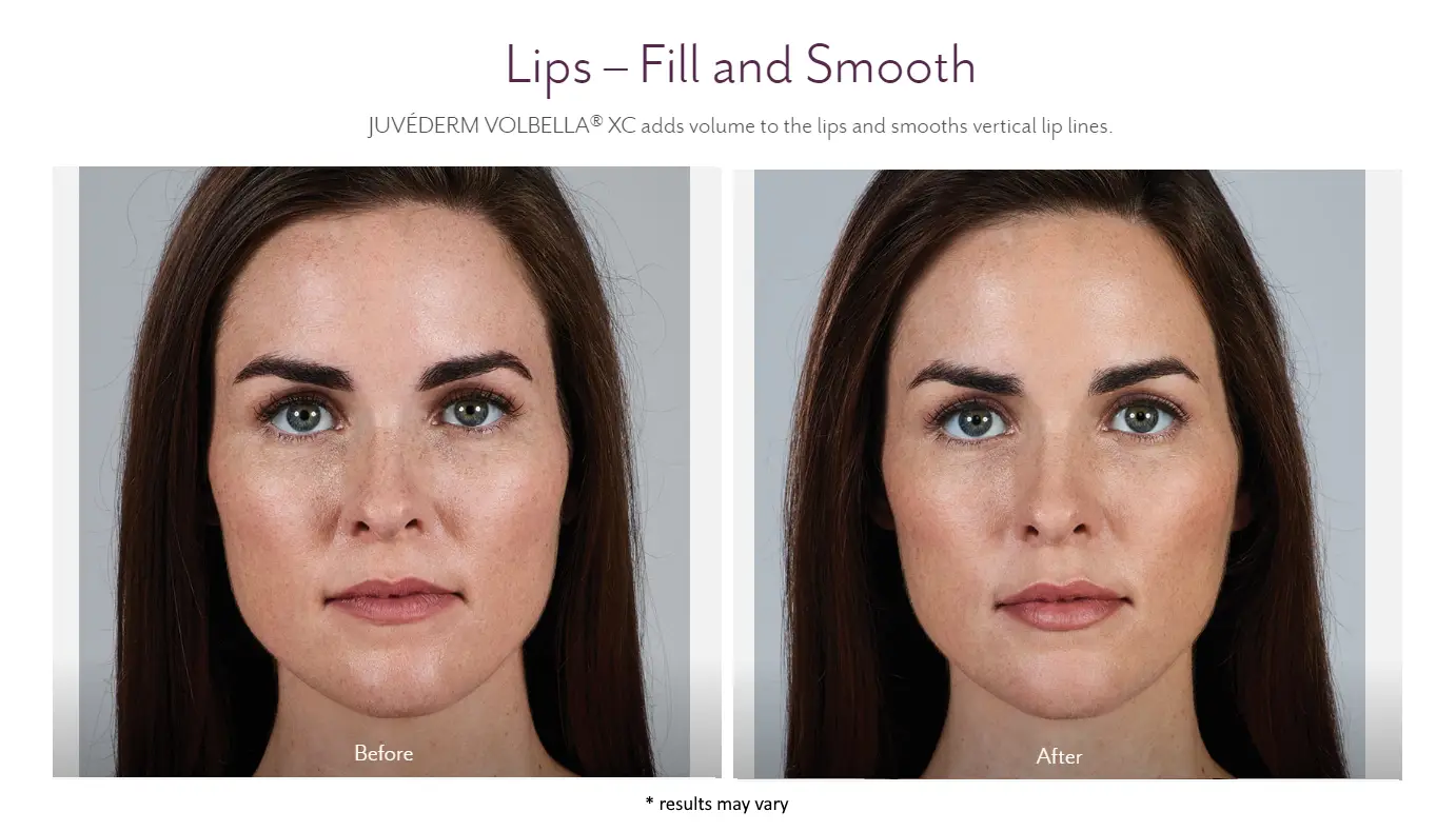 Juvederm Before and After