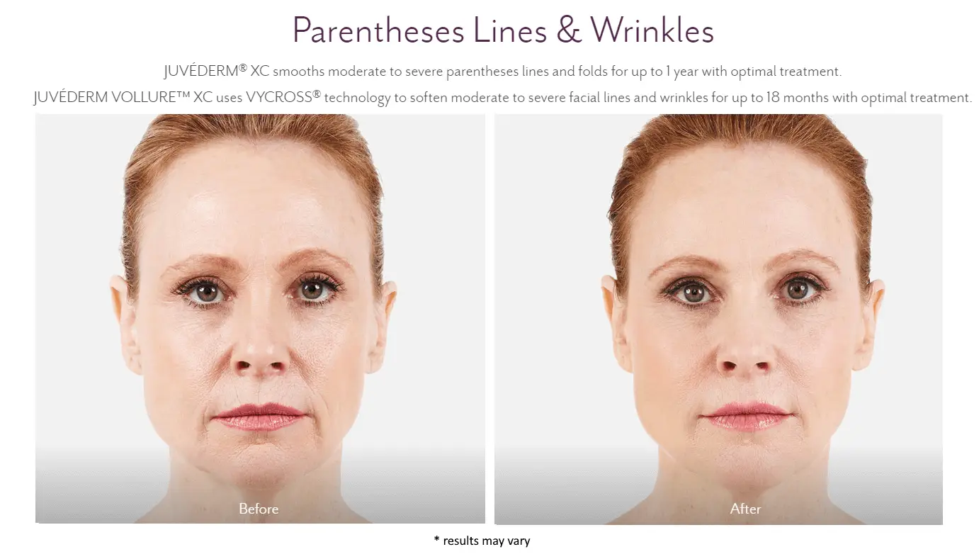Juvederm Before and After