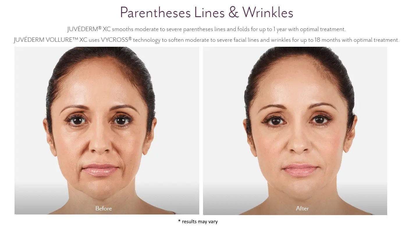 Juvederm Before and After