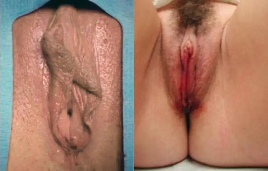 Labiaplasty Before and After