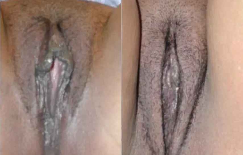 Labiaplasty Before and After