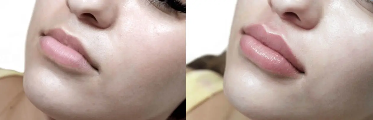 Lips Before and After