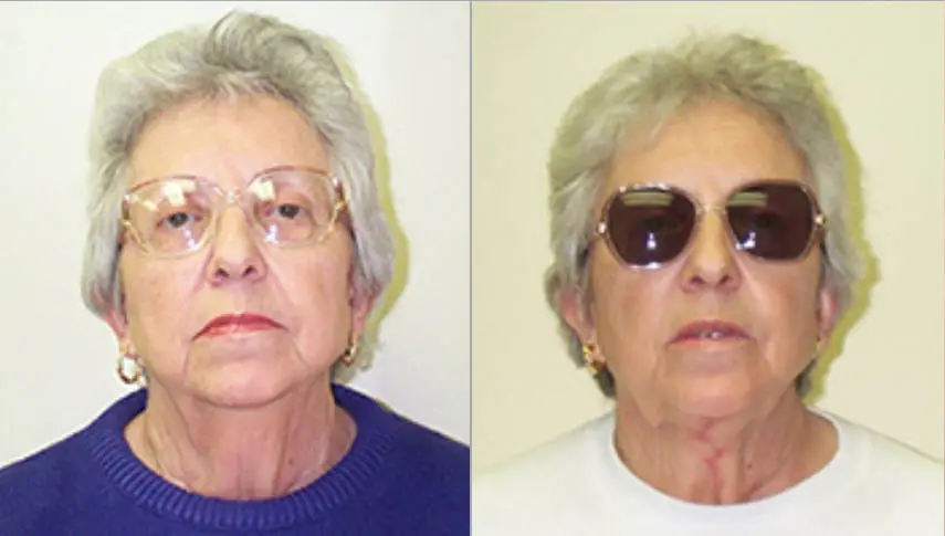 Neck Lifts Before and After