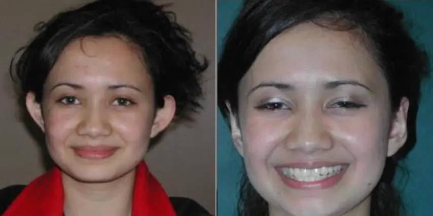 Ear Surgery Before and After