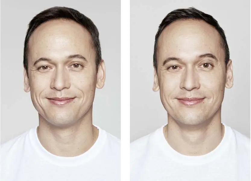 Restylane Before and After