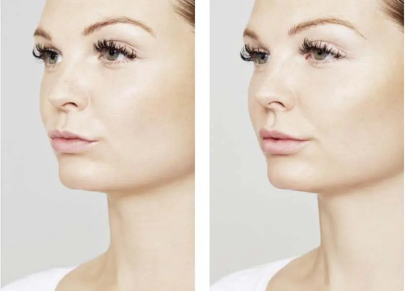 Restylane Before and After