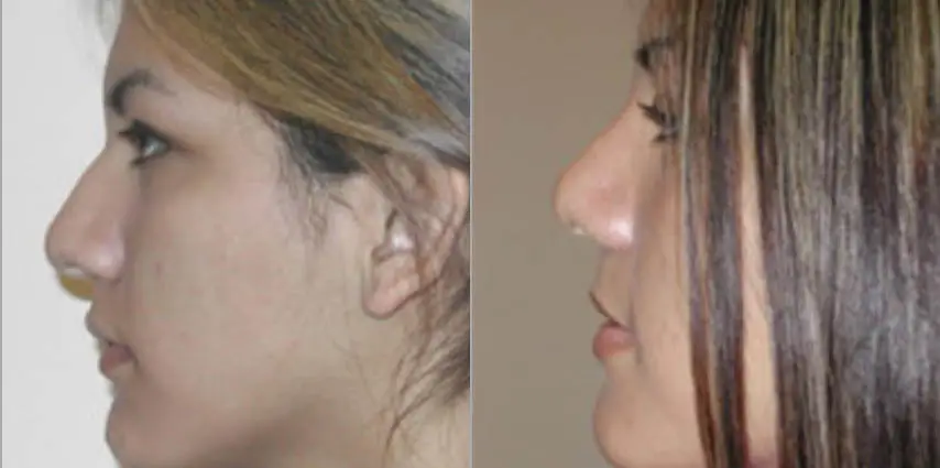 Nose Reshaping Before and After
