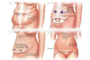 Tummy Tuck Process