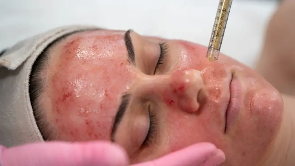 vampire-facial