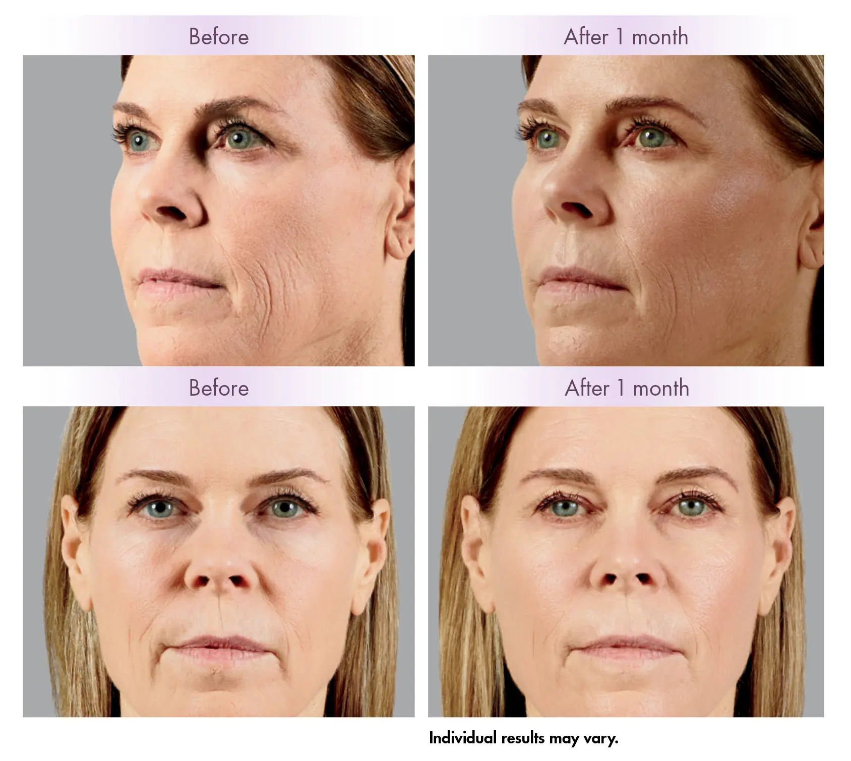 Cheek Lift Before and After