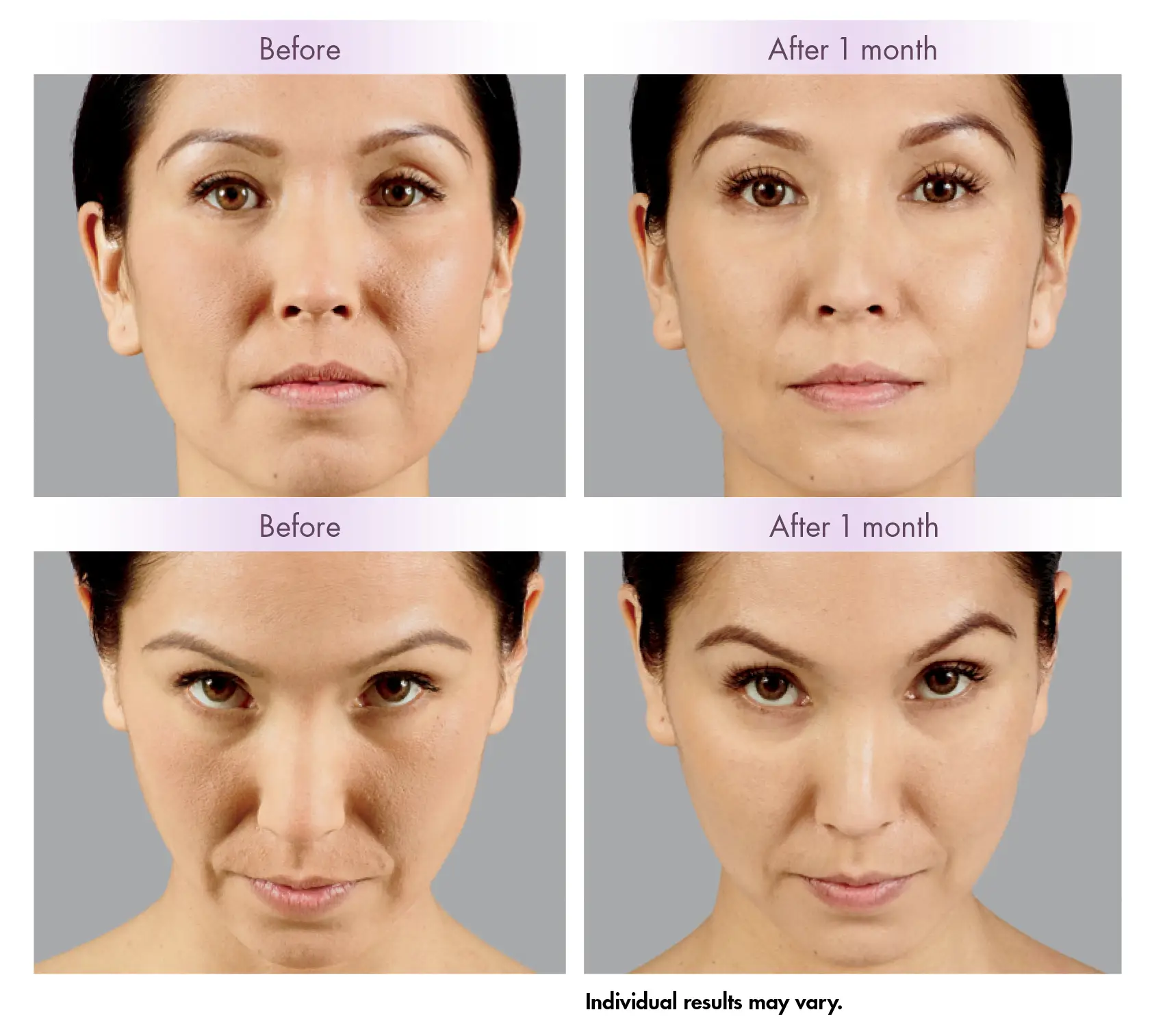 Cheek Lift Before and After