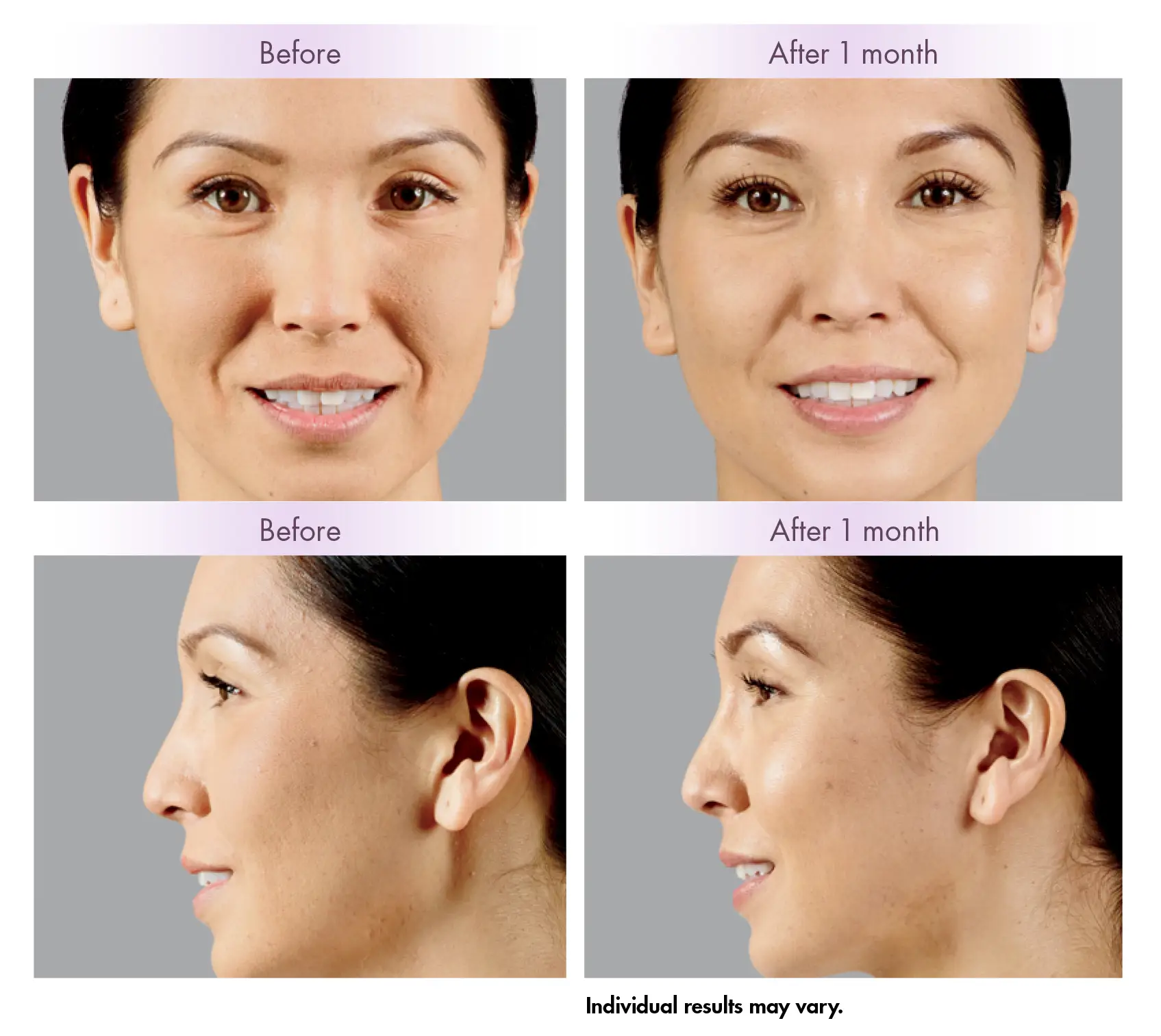 Cheek Lift Before and After