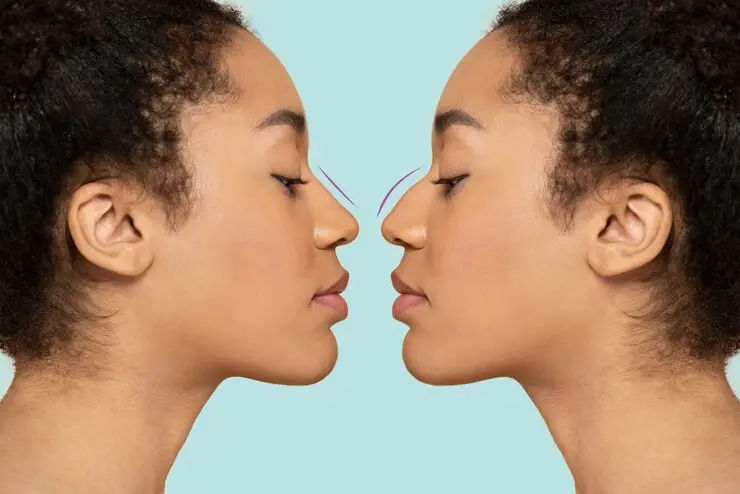 Treating the Ethnic Nose