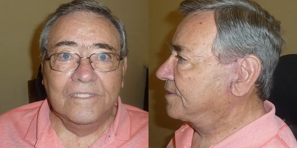 FACELIFT Before & After