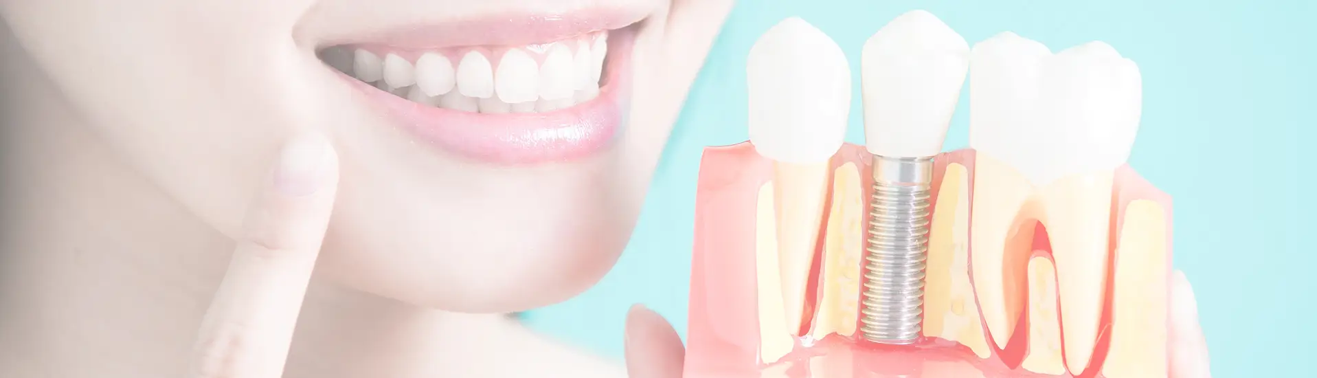 dental-implants-banner dental implants banner | Dentist Windhoek