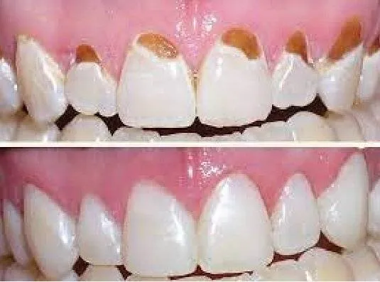 Tooth Decay at Gum Line with Pictures 2023