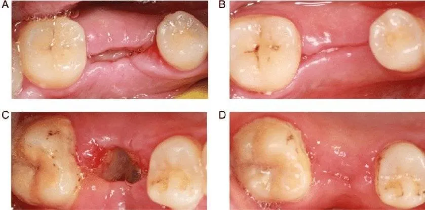 wound healing process tooth extraction site after 3 days